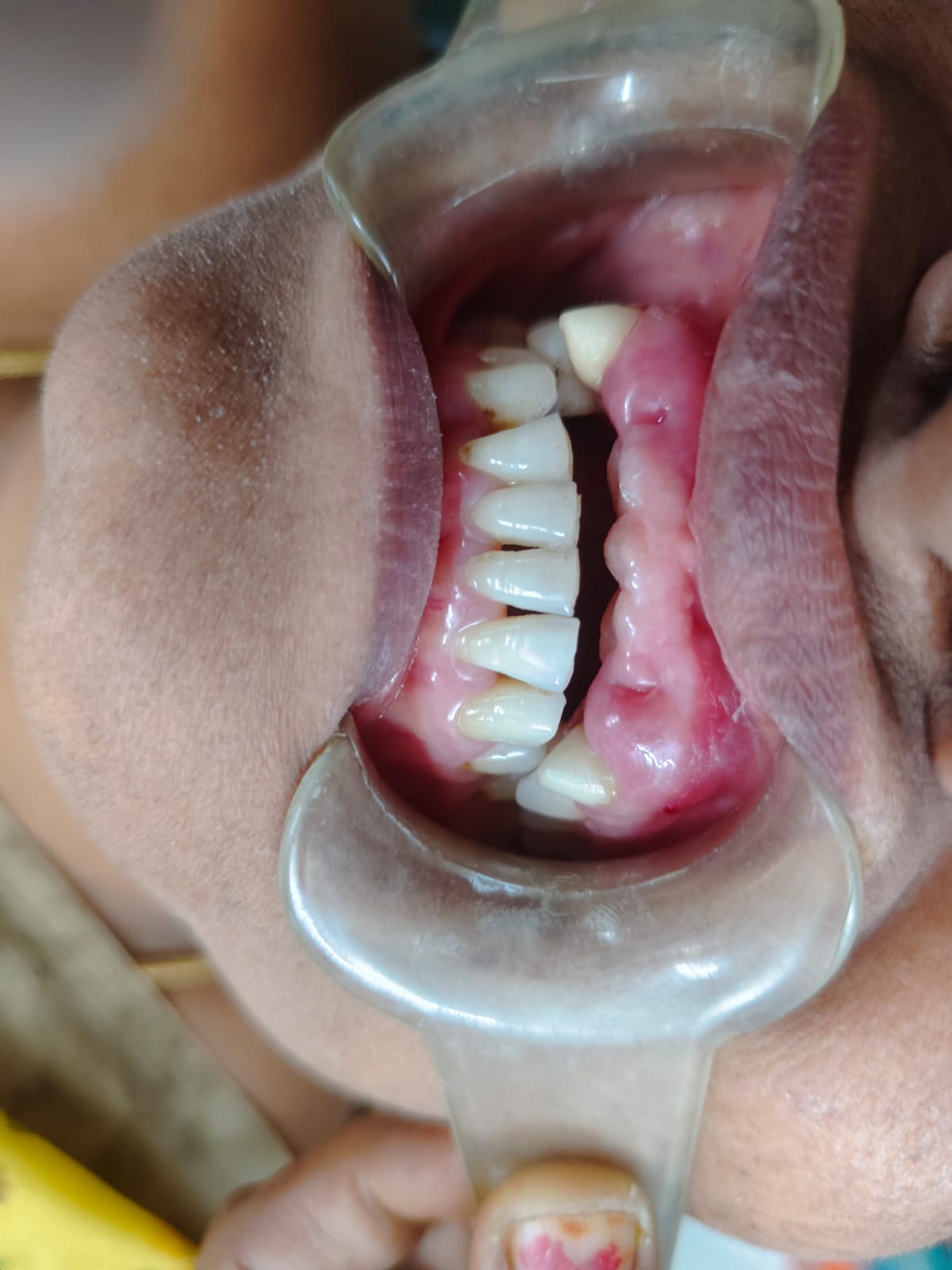 Missing teeth treatment case 1 — Crowns & Bridges