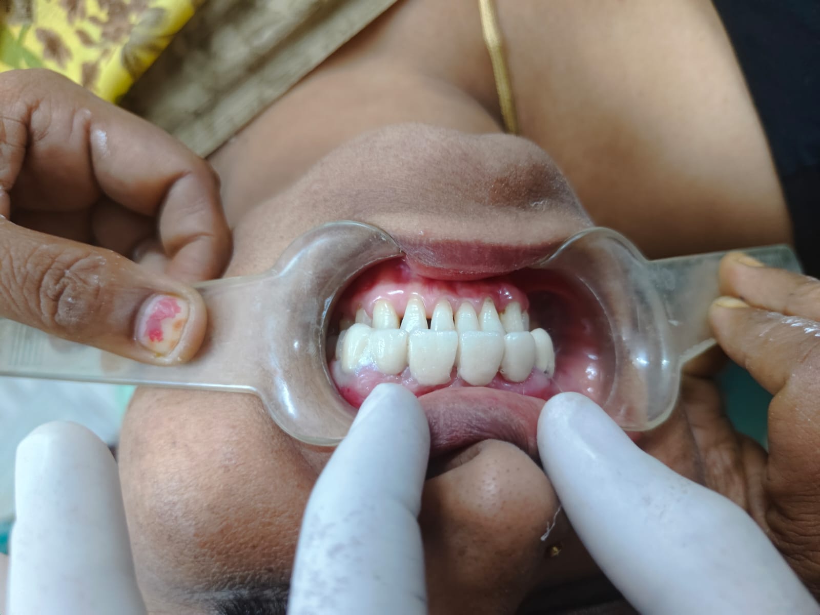 Missing teeth treatment case 2 — Crowns & Bridges
