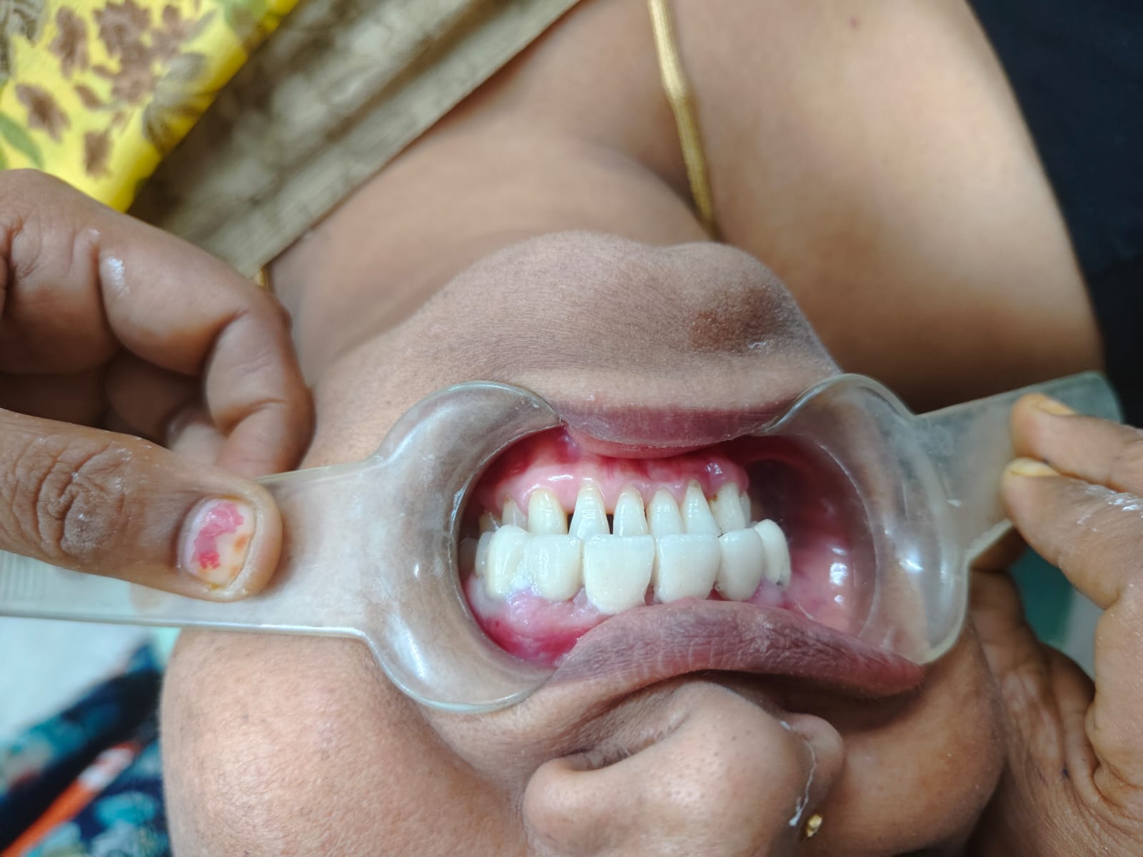 Missing teeth treatment case 3 — Crowns & Bridges