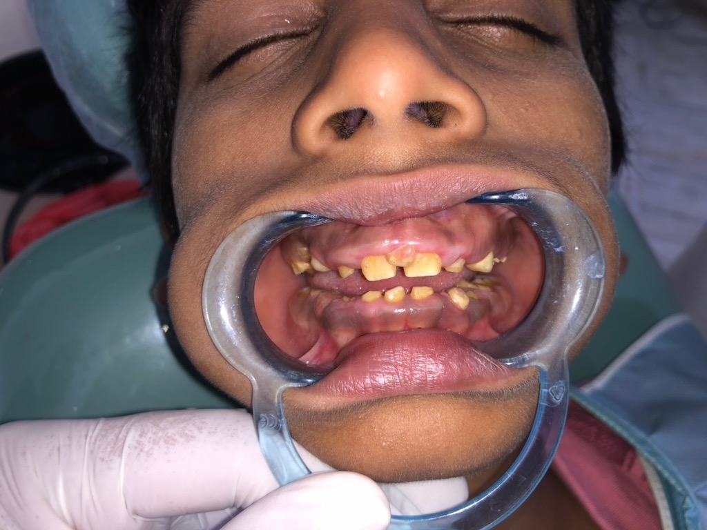 Pre-operative front view — severely decayed primary teeth