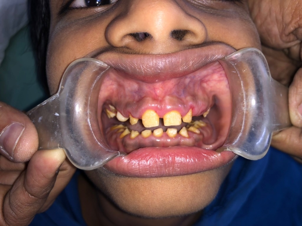 6 months post-operative — front view