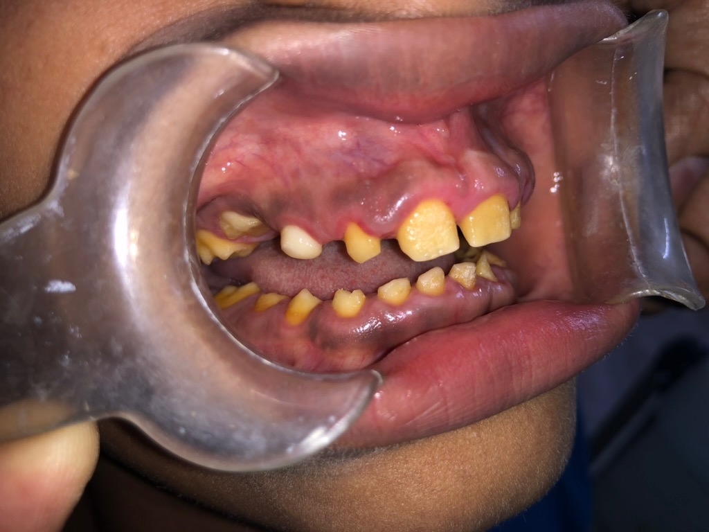 6 months post-operative — left side