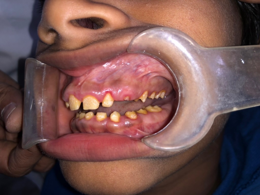 6 months post-operative — right side