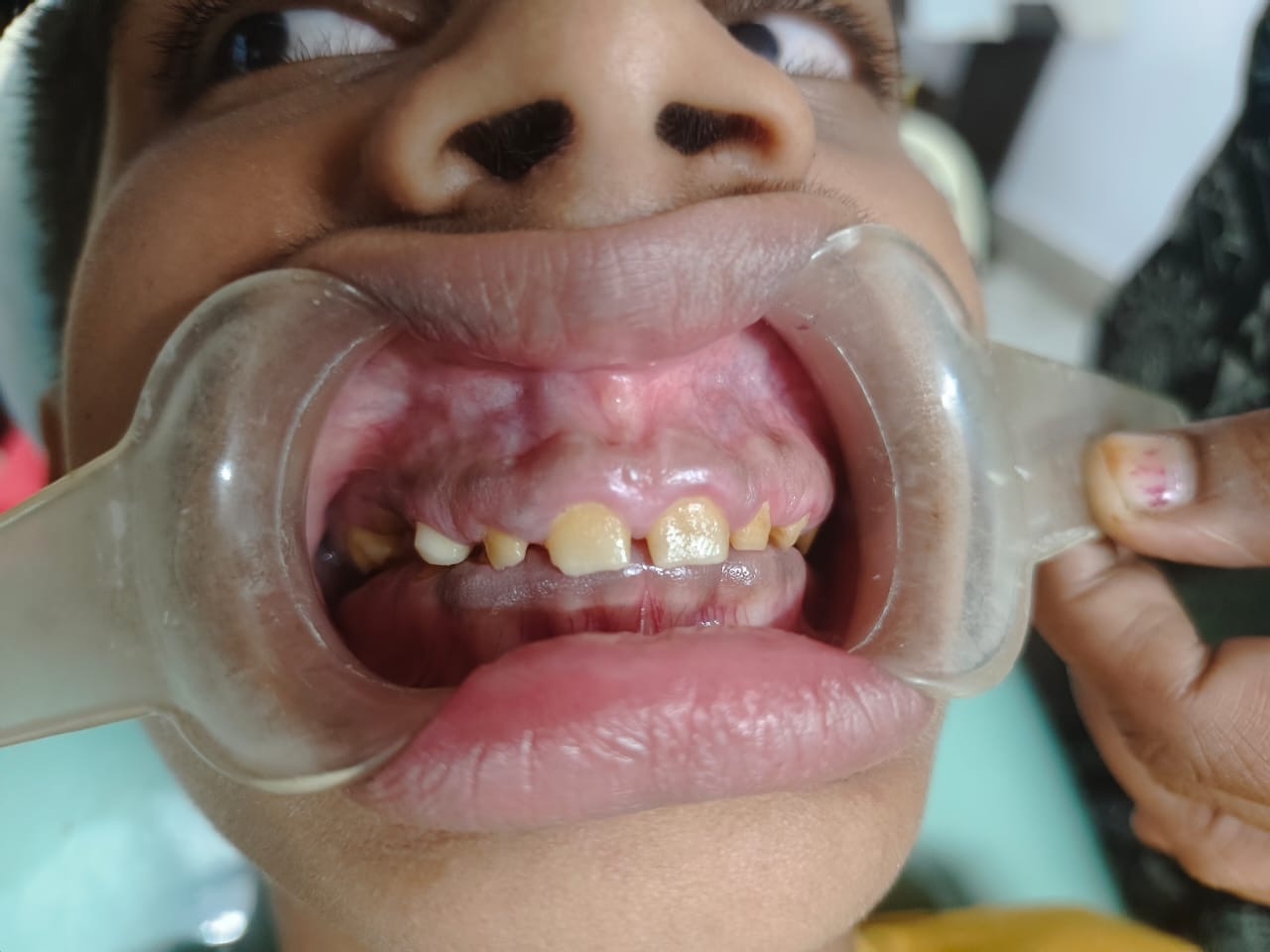 2 years post-operative — front view