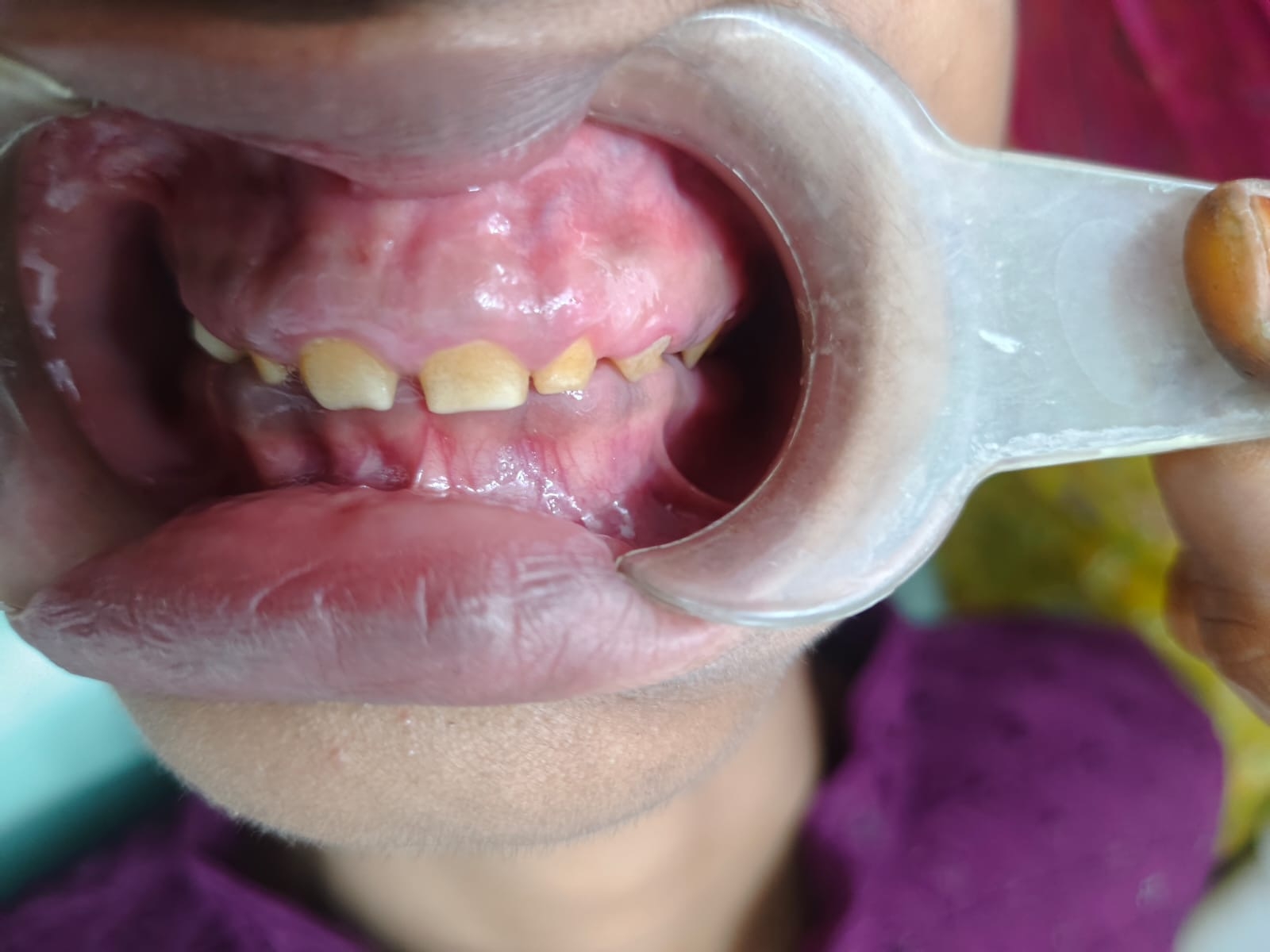 3 years post-operative — front view