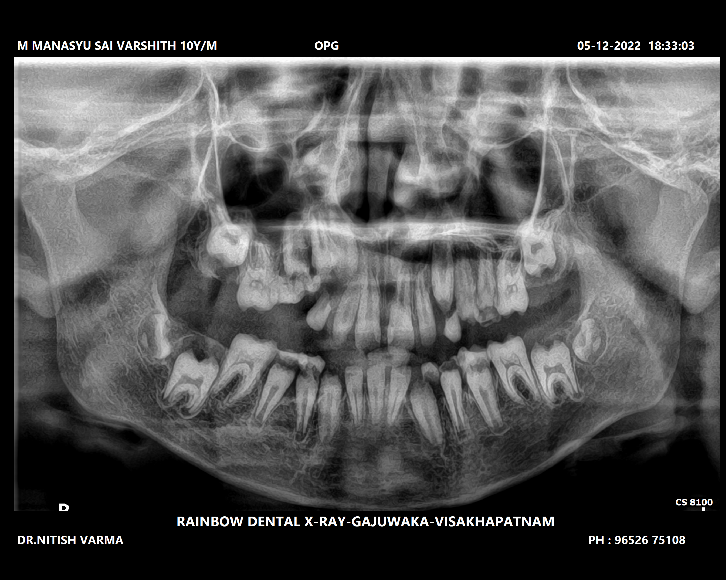OPG X-ray 2022 — before treatment