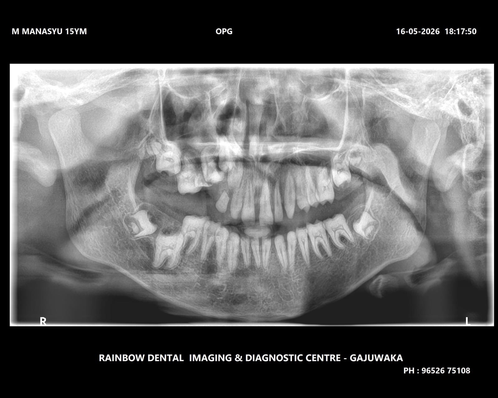OPG X-ray 2026 — after treatment