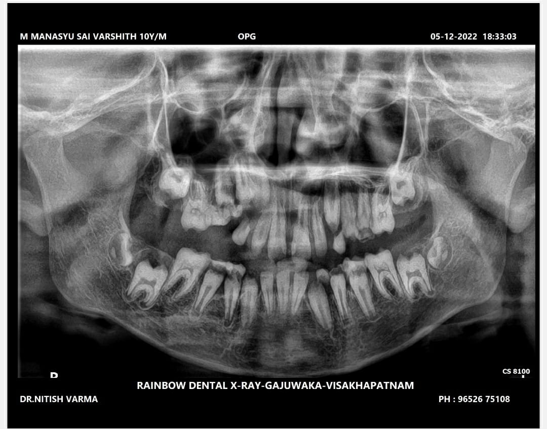 OPG X-ray 2022 — pre-operative panoramic radiograph