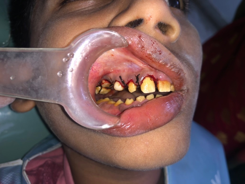 Operative — surgery left side with sutures