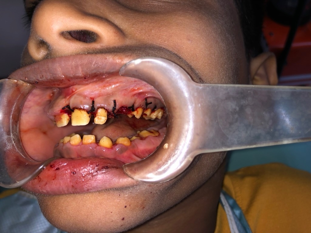 Operative — surgery right side with sutures