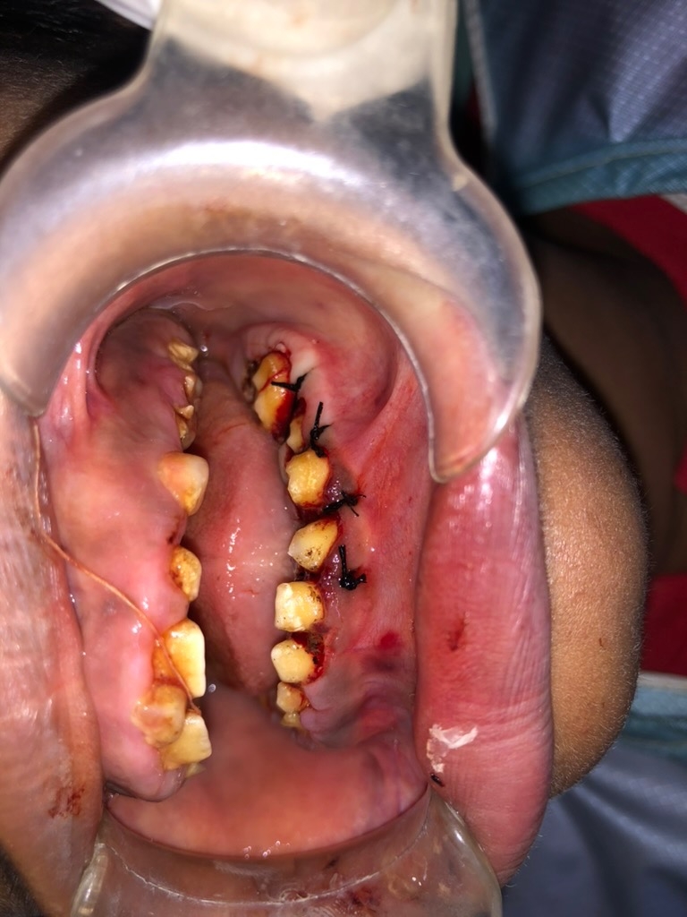 Operative — lower left surgical view
