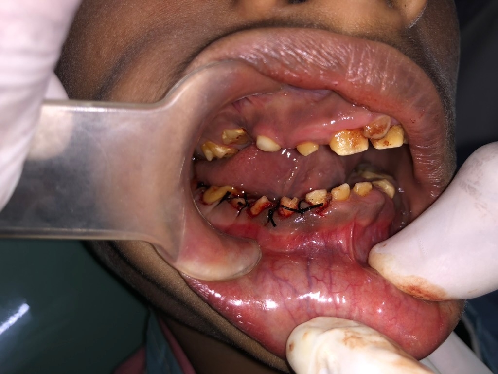 Operative — lower right surgical view