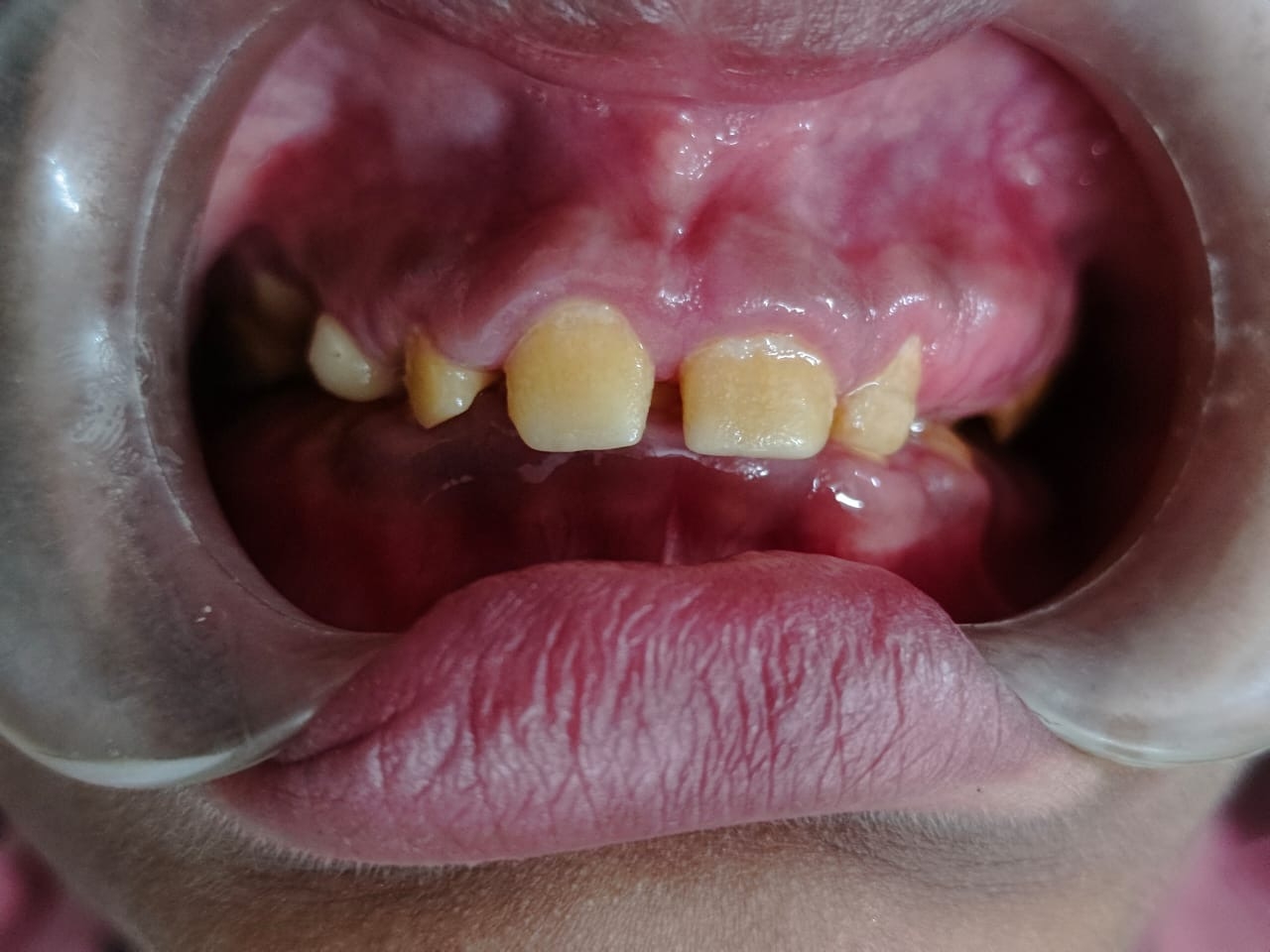 1 month post-operative — upper front view