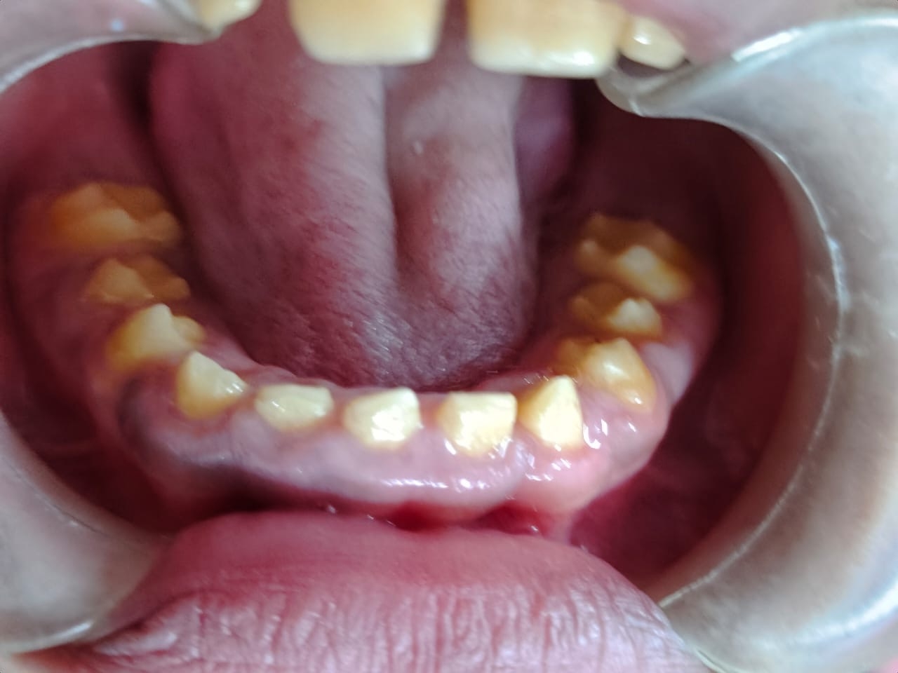 1 month post-operative — front lower view