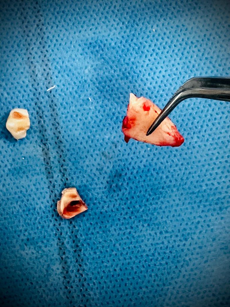 Treatment journey step 7 — Near completion