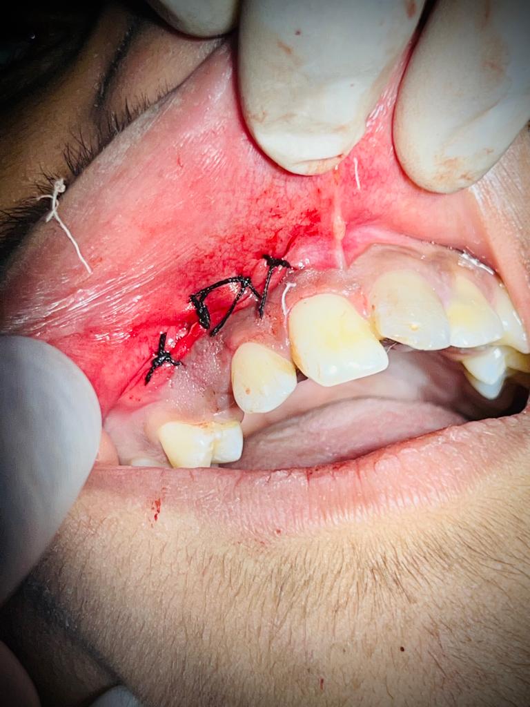 Treatment journey step 9 — Happy smile